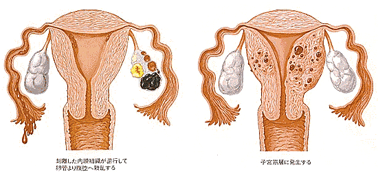 子宮内膜症の食事療法