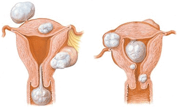 子宮筋腫の種類 模式図