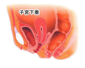 子宮脱に関する手術療法 秋山記念病院 公式サイト