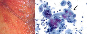 水疱をみる局所と感染細胞（パパニコロウ染色）